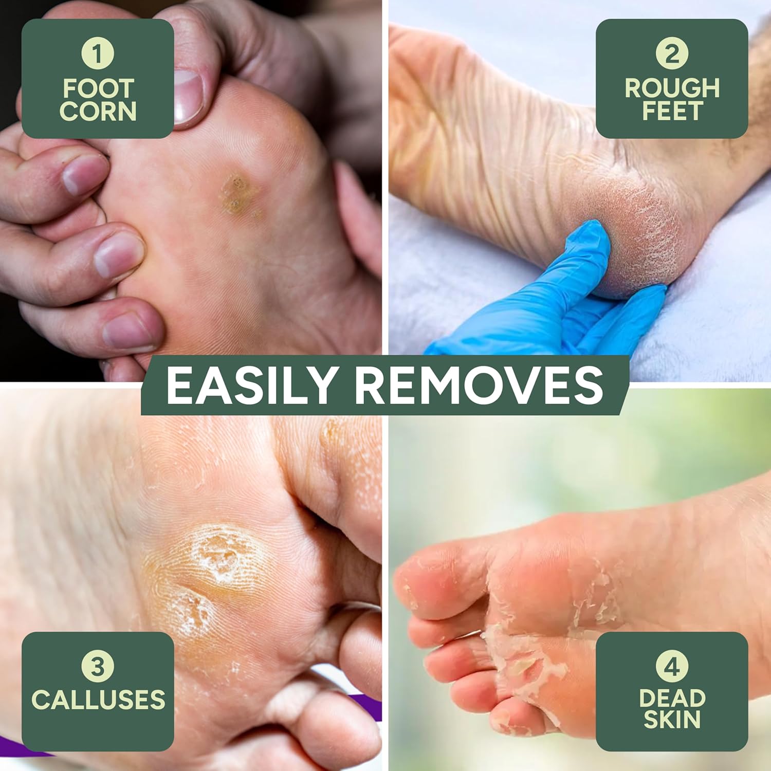 Zuvo Foot File for Hard Skin - Surgical Stainless Steel Callus Remover (XL) with Skin Catcher | Wet & Dry Pedicure Foot Scraper for Cracked Heels & Dead Skin Removal